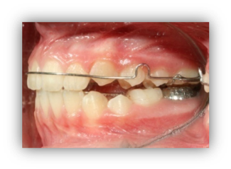 Aligner les dents à Paris chez un chirurgien dentiste
