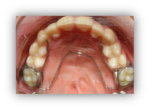 Gouttière occlusale et bruxisme - Bienvenue à l'espace dentaire de